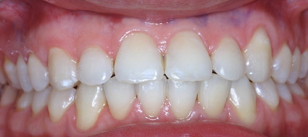 ホワイトニング